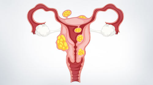 PCOS-PCOD | Petals Health